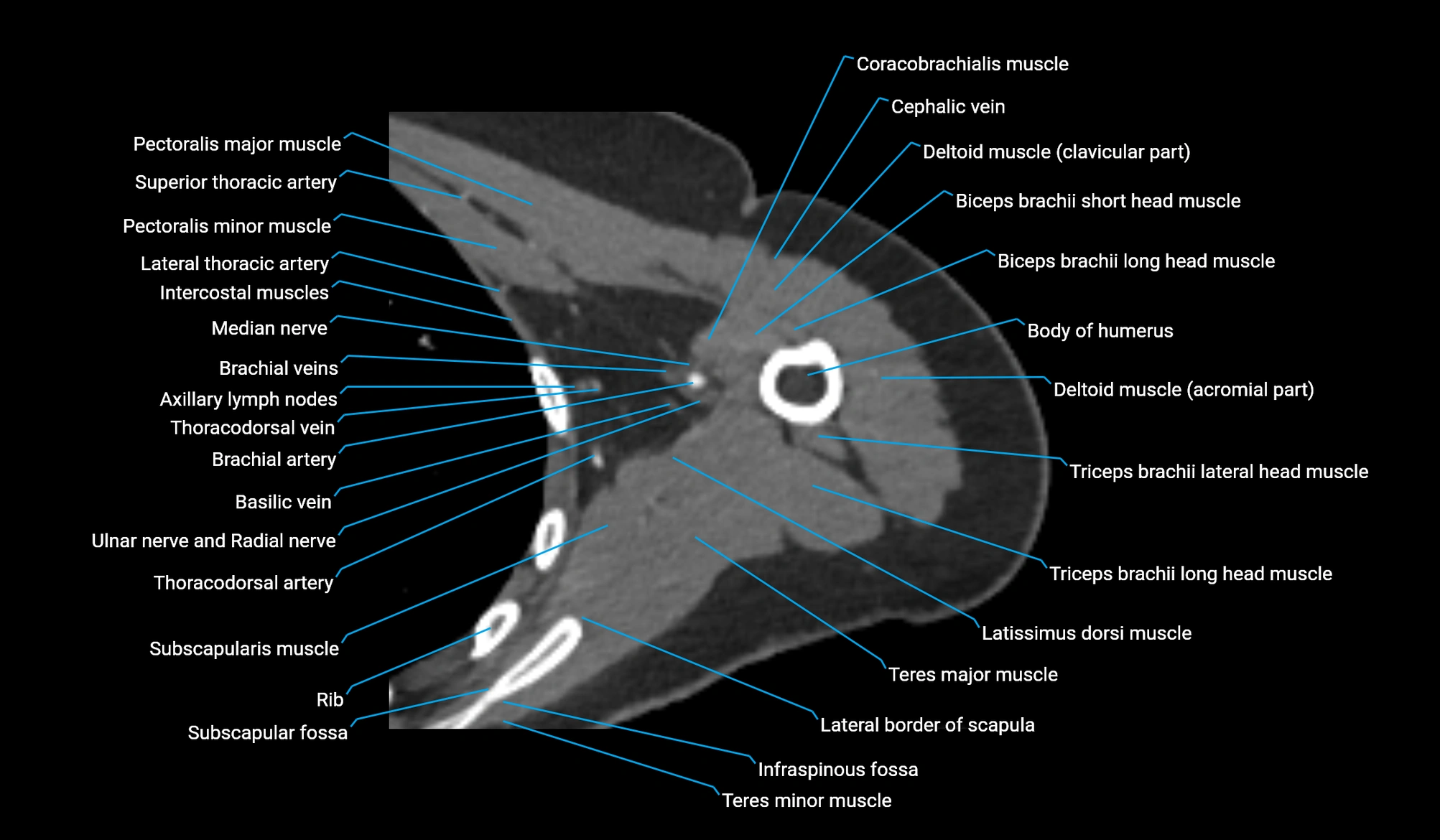 CT upper arm axial  cross sectional anatomy labelled radiology image -00150.webp
